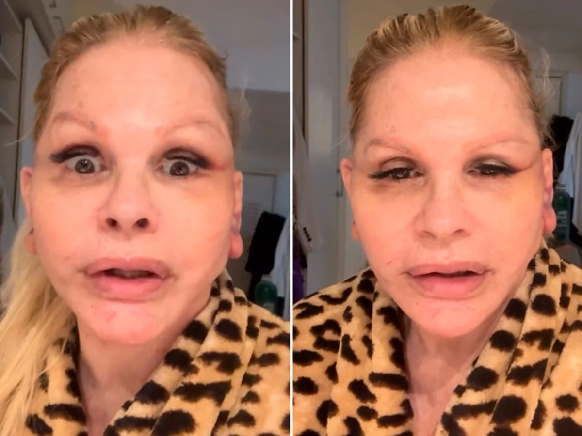 Monique Evans passa por minilifting facial e sistema de banco não reconhece seu rosto após cirurgia