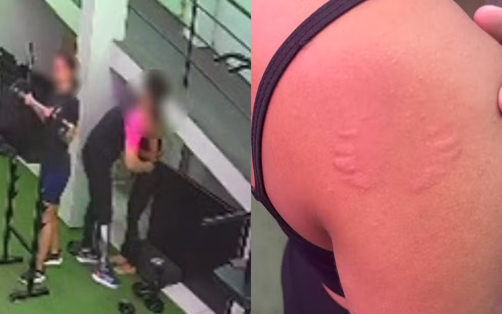 Professora denuncia instrutor de academia por assédio após ser mordida no ombro durante treino no Recife