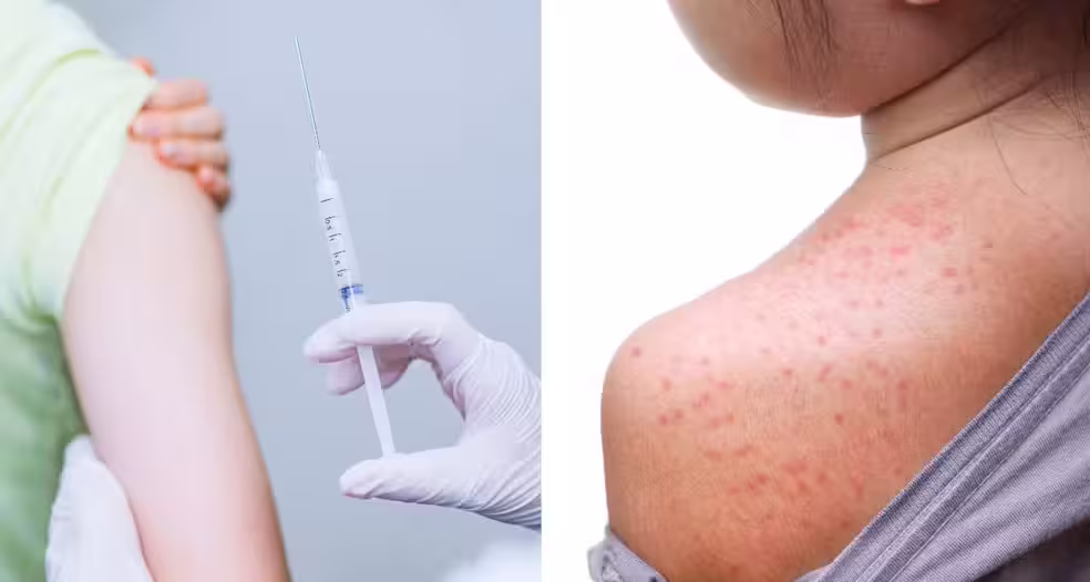 Casos de sarampo aumentam nas Américas e OPAS reforça alerta sobre vacinação